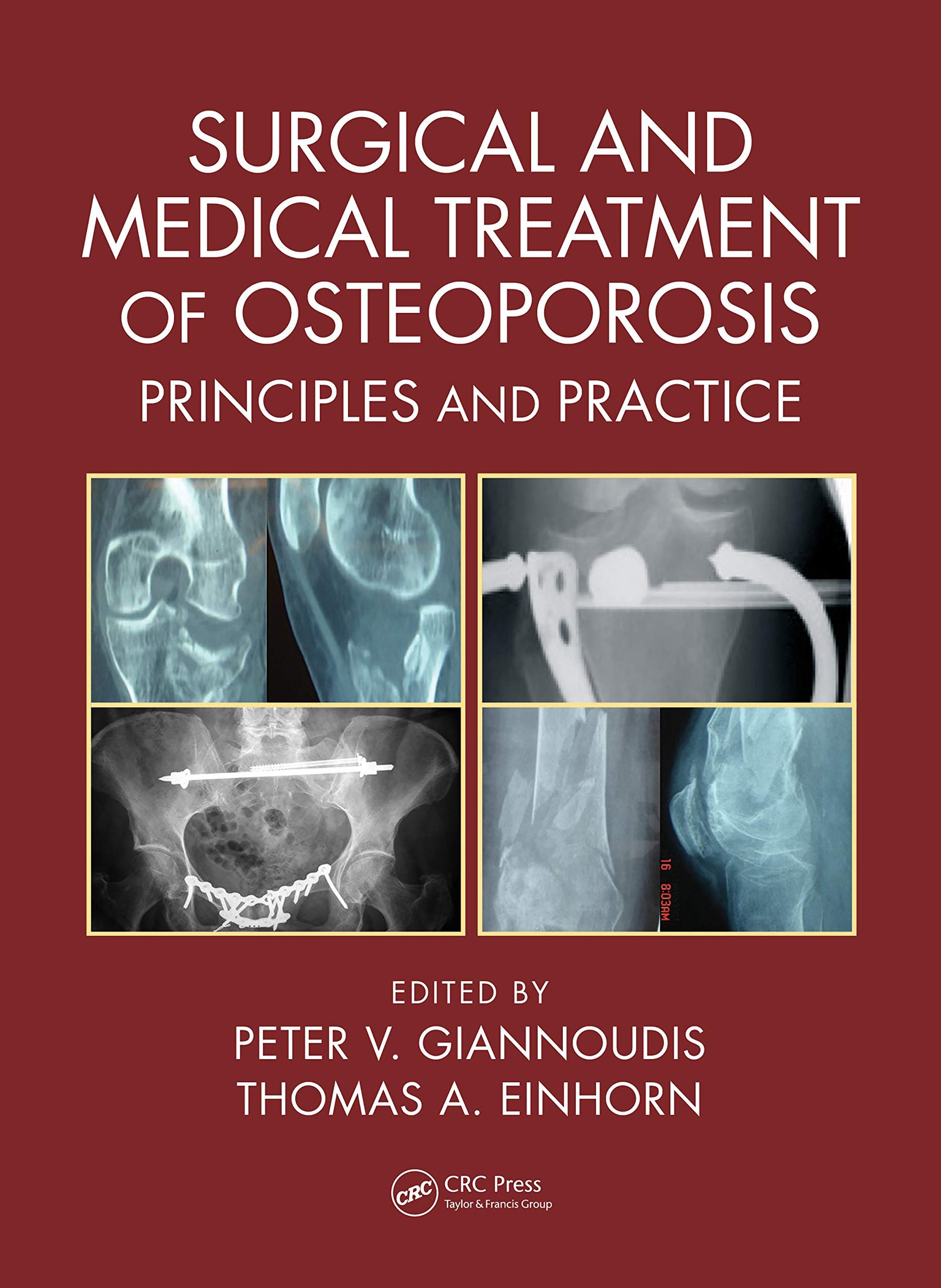 Surgical and Medical Treatment of Osteoporosis: Principles and Practice - 1st Edition